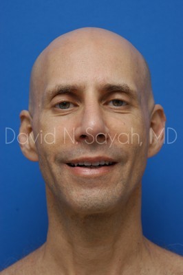 Fat Injection (face) Before and After | simply males