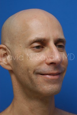 Fat Injection (face) Before and After | simply males