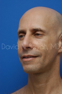 Fat Injection (face) Before and After | simply males