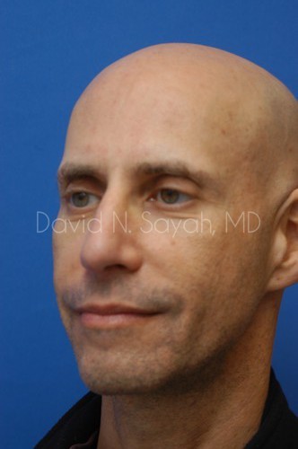 Fat Injection (face) Before and After | simply males