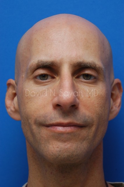 Fat Injection (face) Before and After | simply males