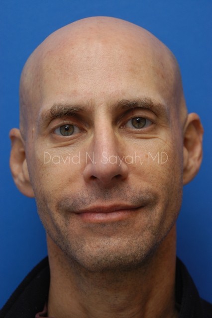 Fat Injection (face) Before and After | simply males