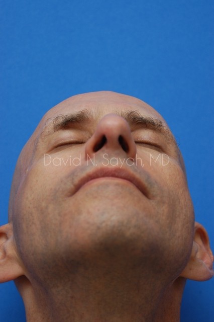 Fat Injection (face) Before and After | simply males