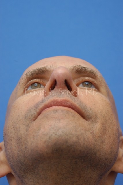 Fat Injection (face) Before and After | simply males