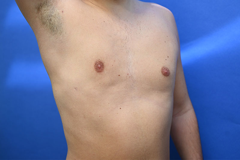 Gynecomastia Before and After | simply males