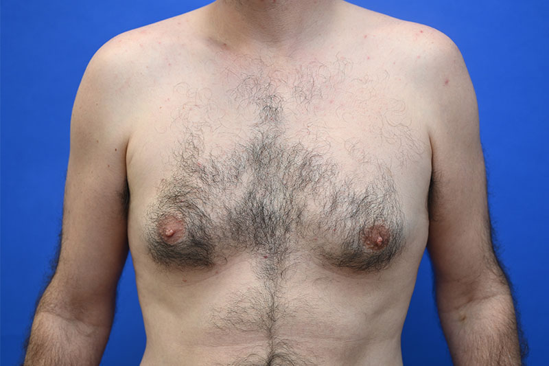 Gynecomastia Before and After | simply males