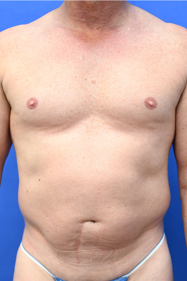 Liposuction Before and After | simply males