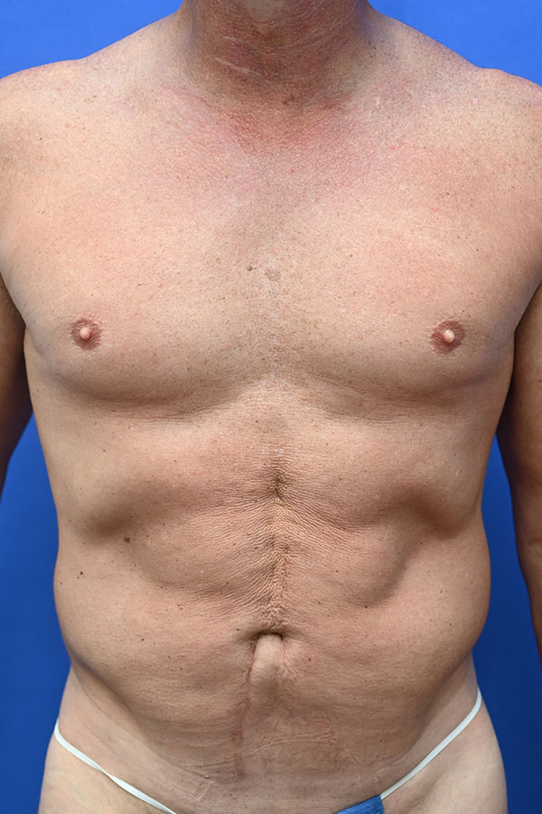 Liposuction Before and After | simply males