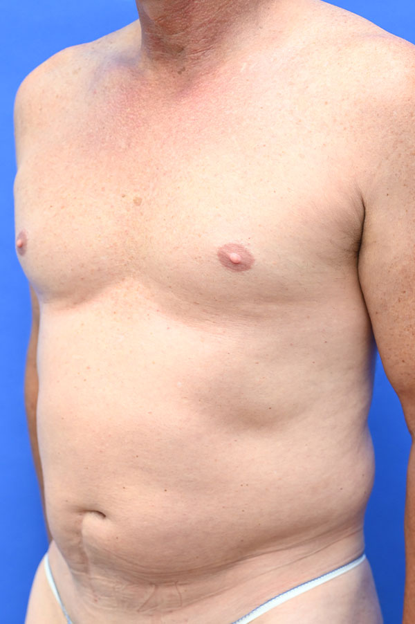 Liposuction Before and After | simply males