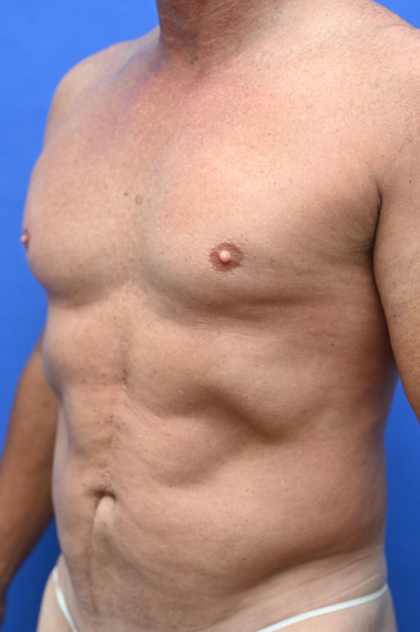 Liposuction Before and After | simply males