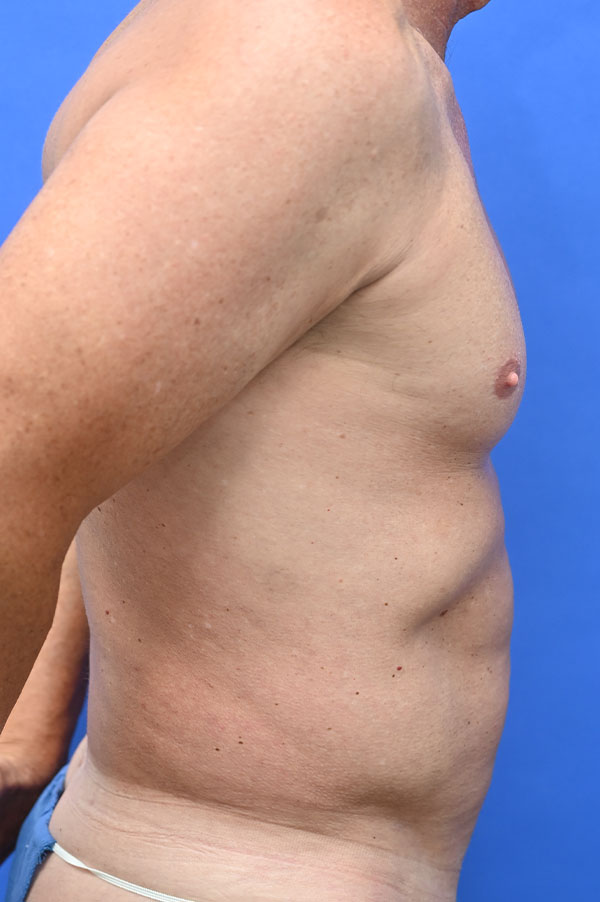 Liposuction Before and After | simply males