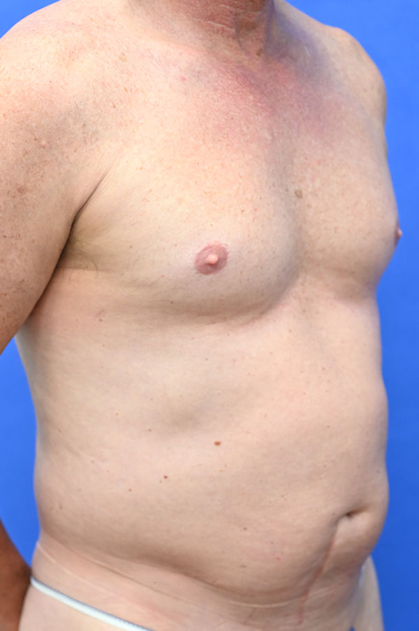 Liposuction Before and After | simply males