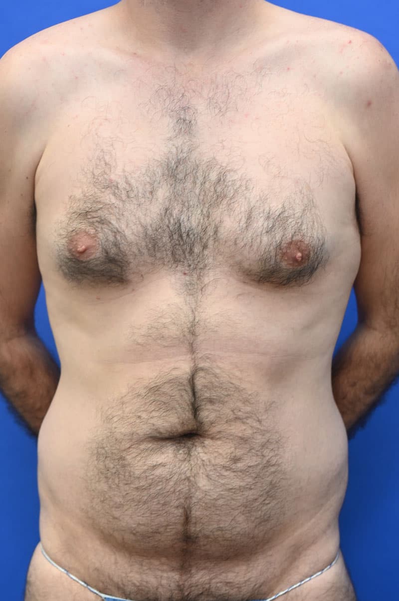 Liposuction Before and After | simply males