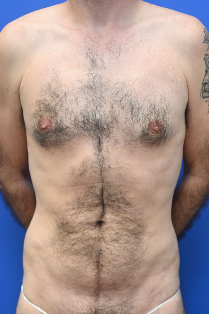 Liposuction Before and After | simply males