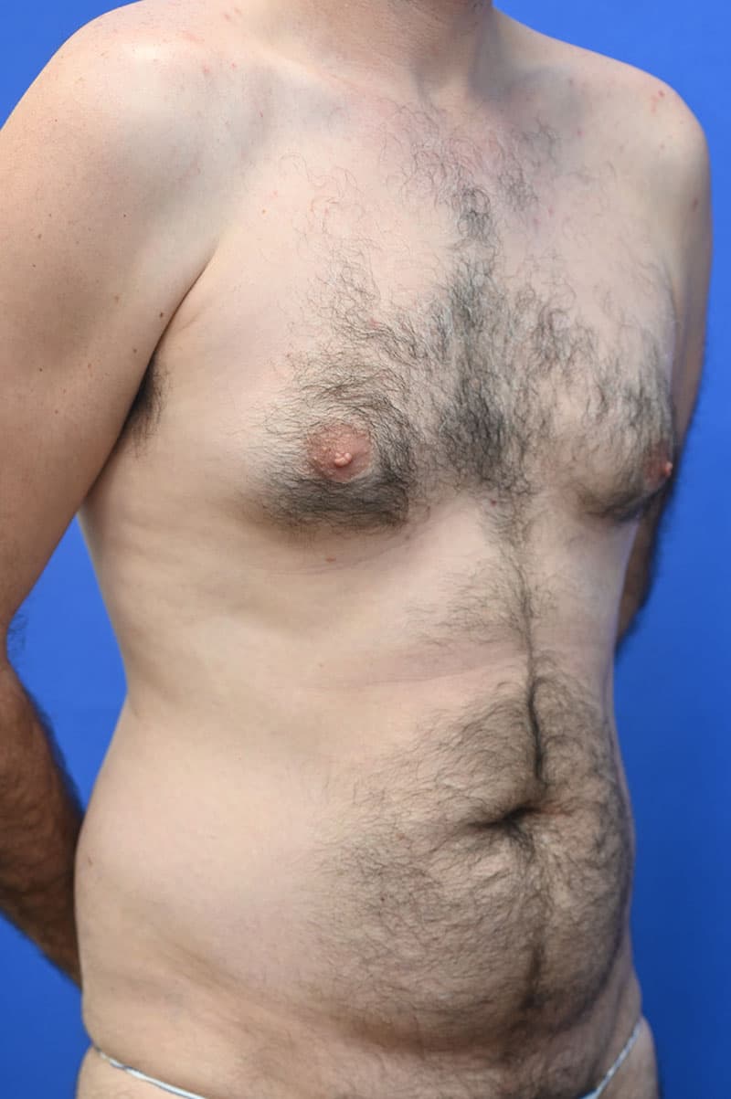 Liposuction Before and After | simply males