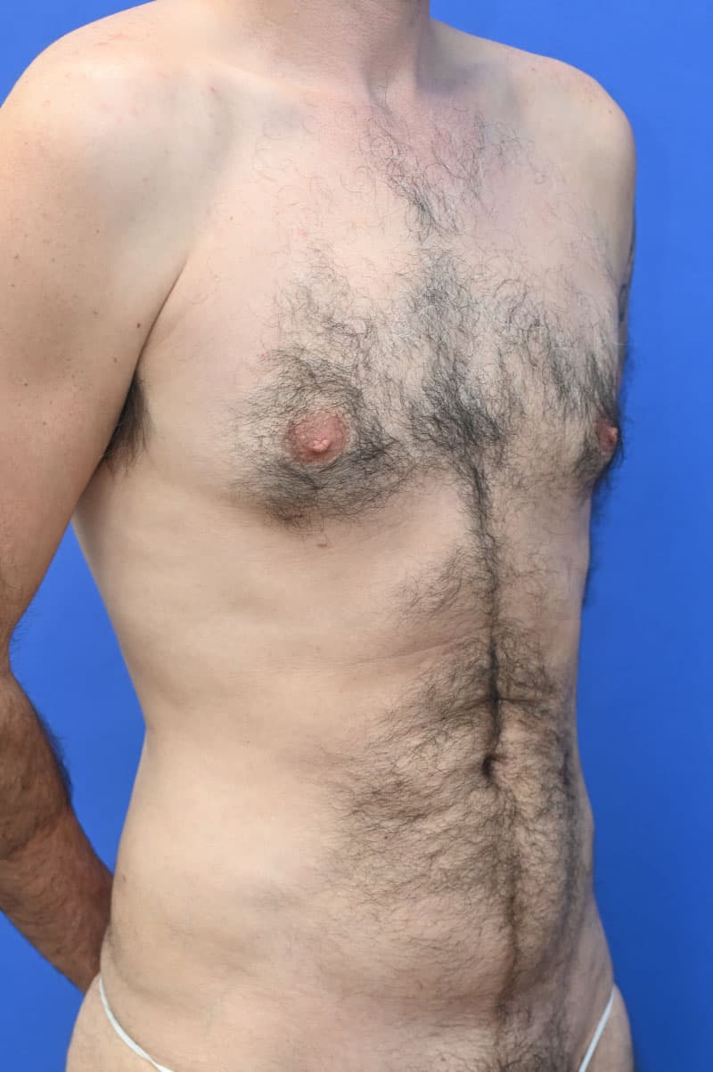 Liposuction Before and After | simply males