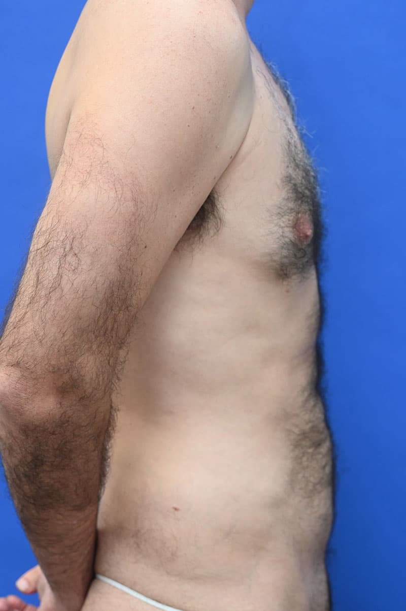 Liposuction Before and After | simply males