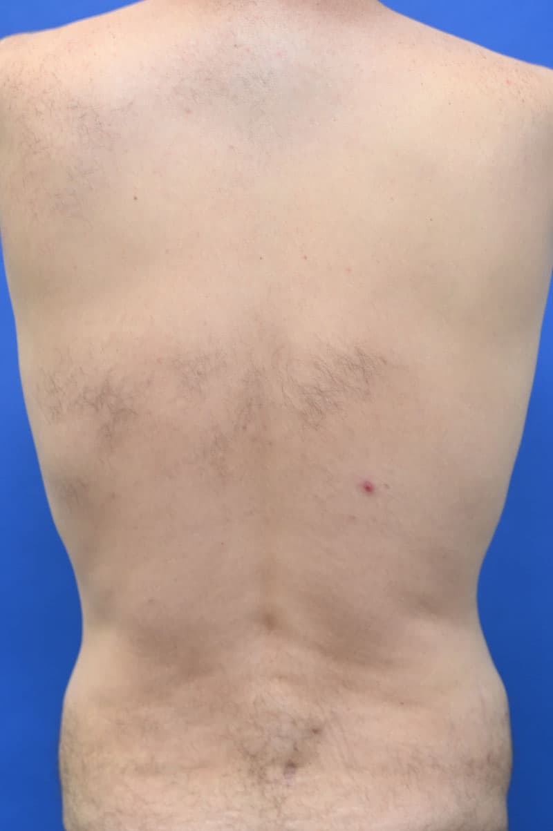 Liposuction Before and After | simply males