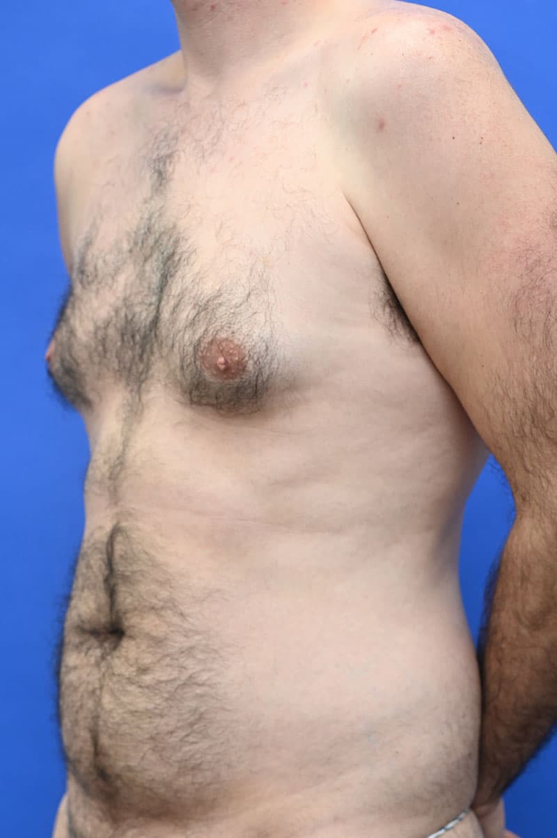 Liposuction Before and After | simply males