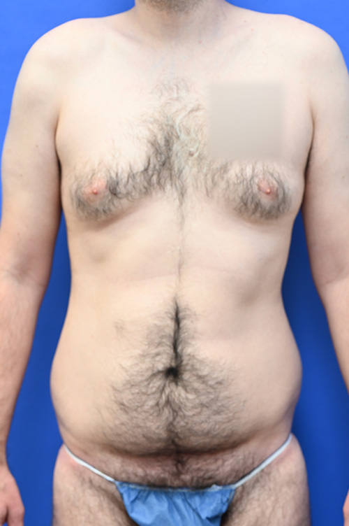 Liposuction Before and After | simply males