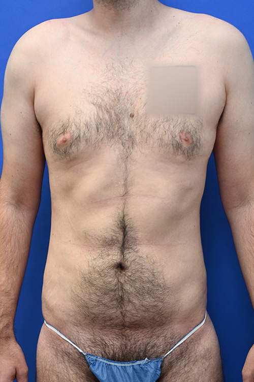 Liposuction Before and After | simply males