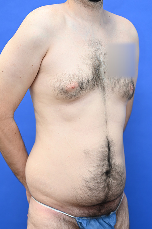 Liposuction Before and After | simply males