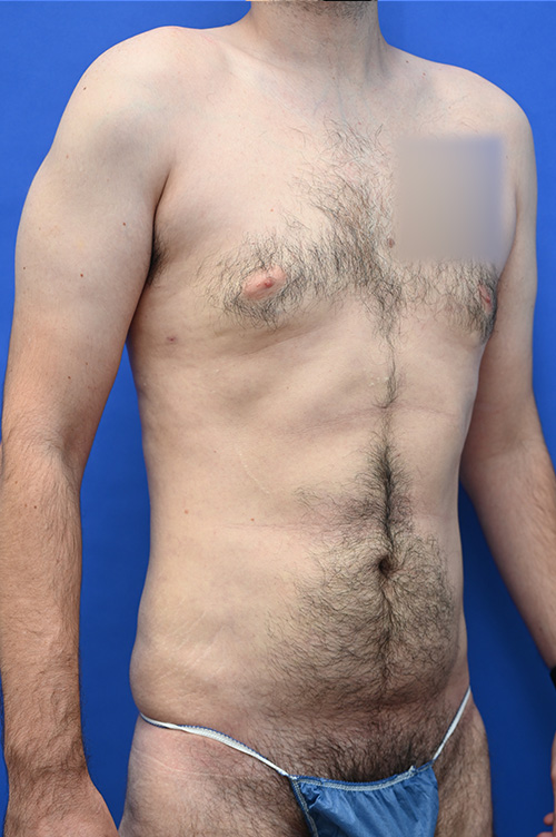 Liposuction Before and After | simply males