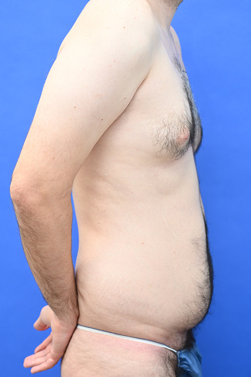 Liposuction Before and After | simply males