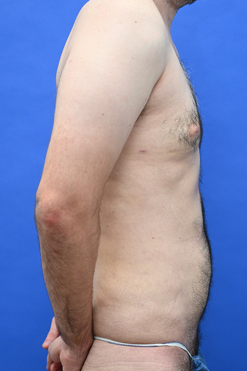 Liposuction Before and After | simply males