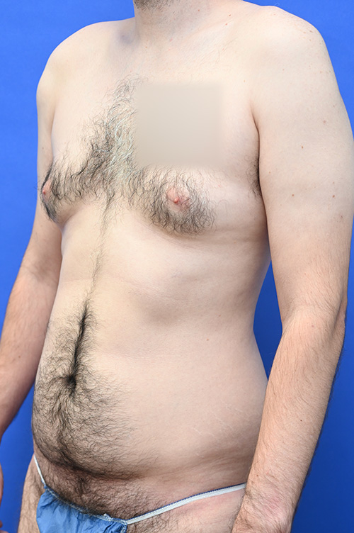 Liposuction Before and After | simply males