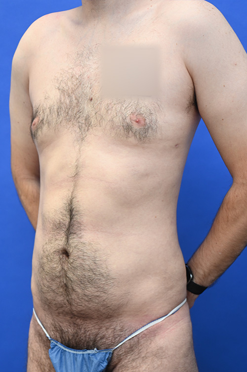 Liposuction Before and After | simply males