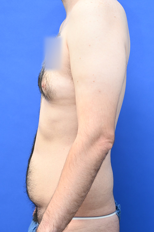 Liposuction Before and After | simply males