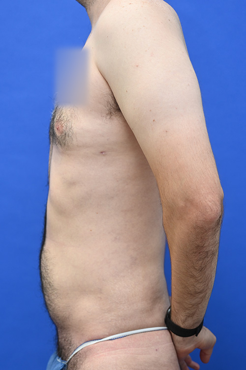 Liposuction Before and After | simply males