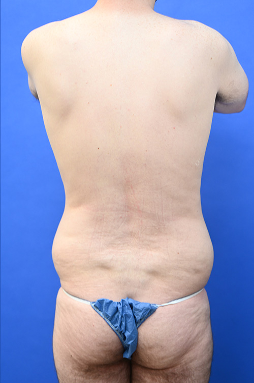 Liposuction Before and After | simply males