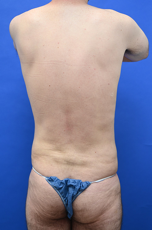 Liposuction Before and After | simply males