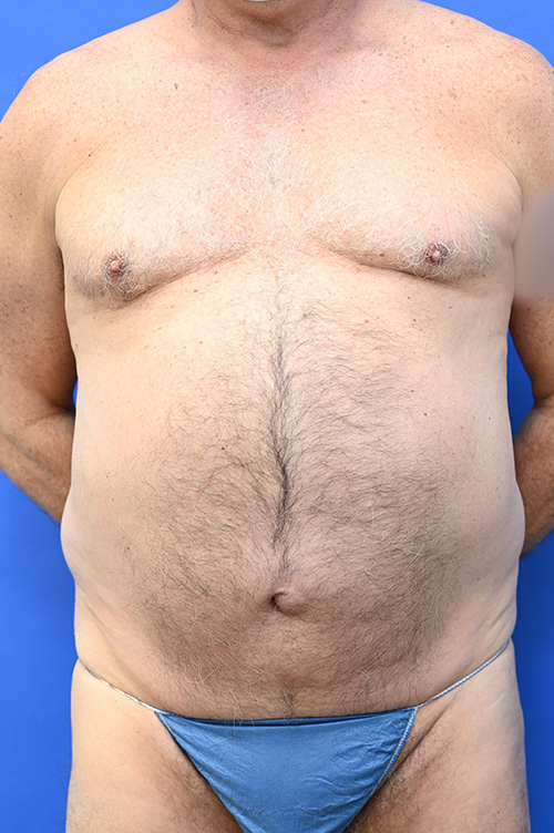 Liposuction Before and After | simply males