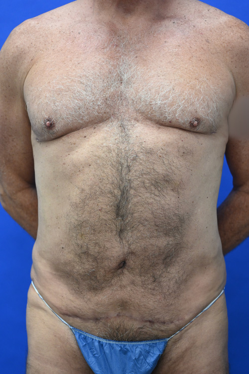 Liposuction Before and After | simply males