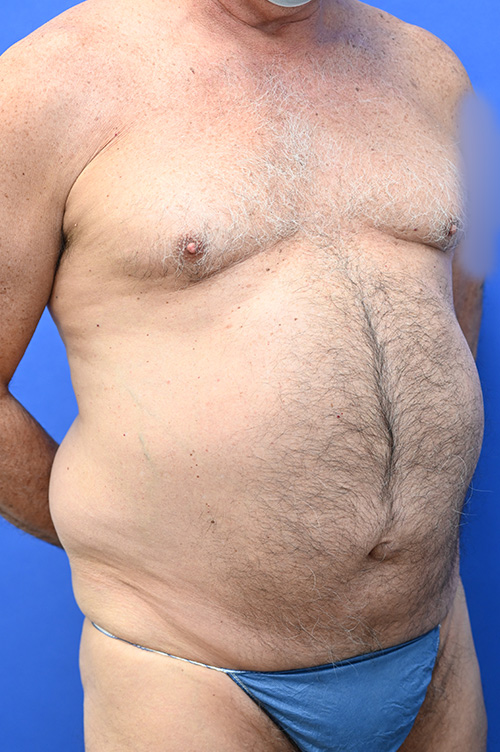 Liposuction Before and After | simply males