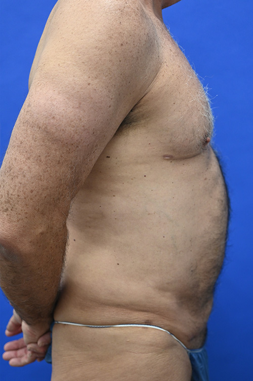 Liposuction Before and After | simply males