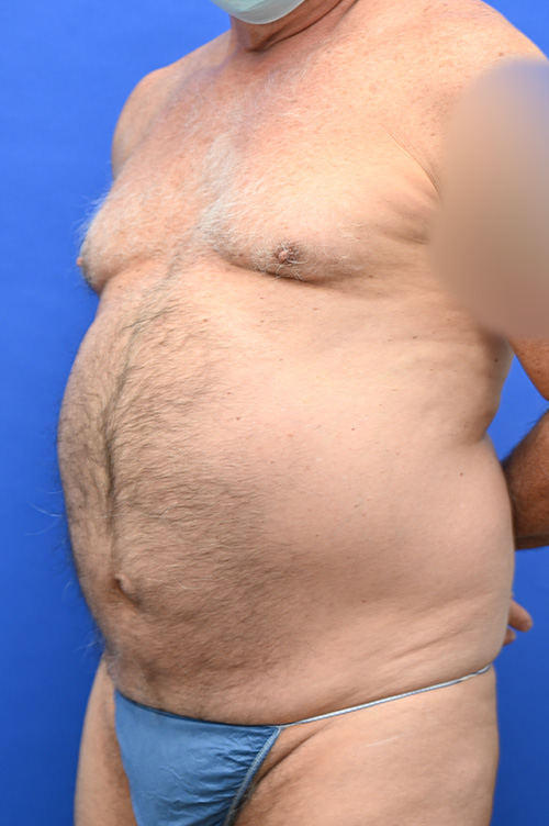 Liposuction Before and After | simply males