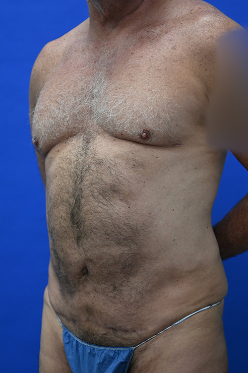 Liposuction Before and After | simply males