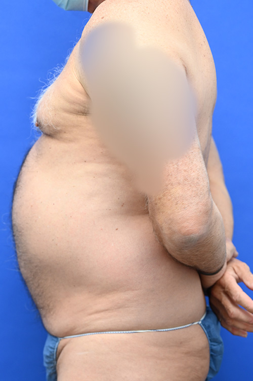 Liposuction Before and After | simply males