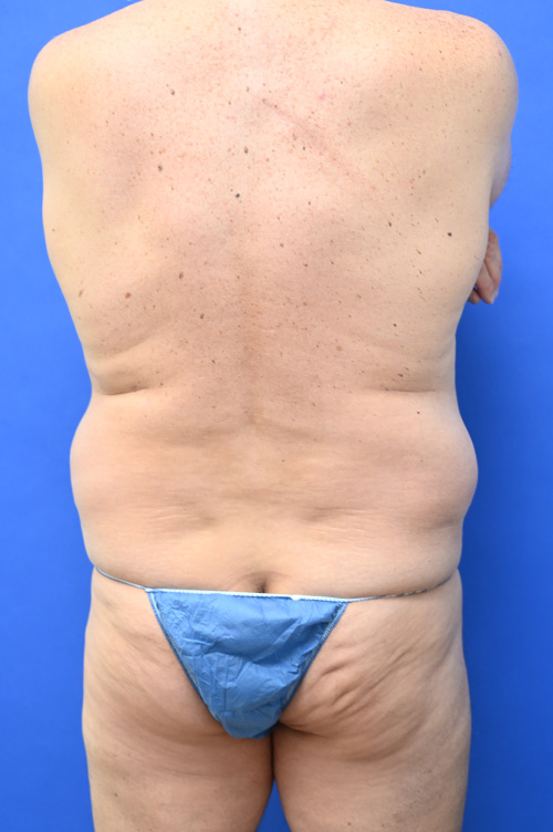 Liposuction Before and After | simply males