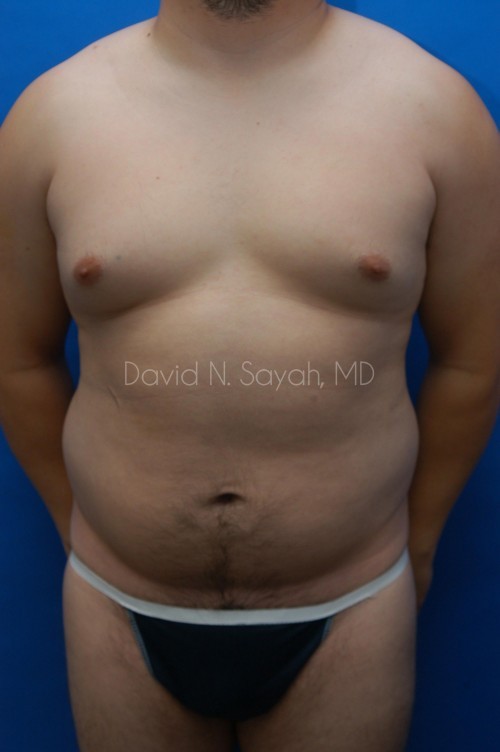 Liposuction Before and After | simply males