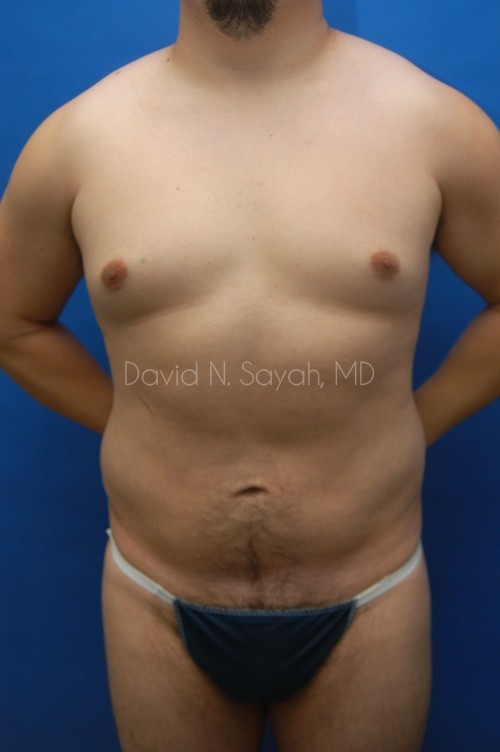 Liposuction Before and After | simply males