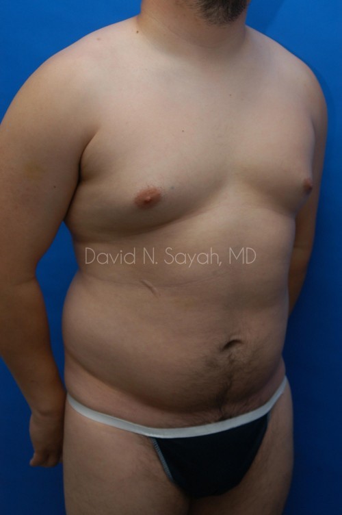 Liposuction Before and After | simply males