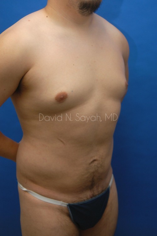 Liposuction Before and After | simply males