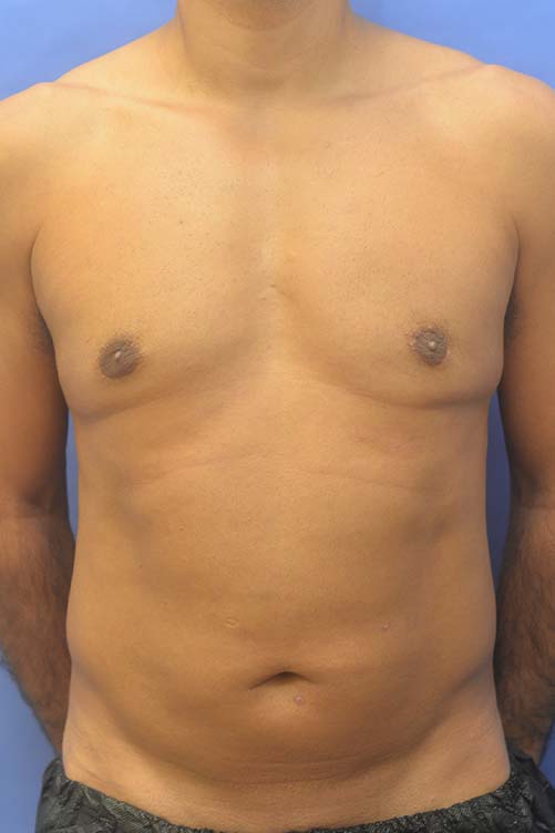 Liposuction Before and After | simply males