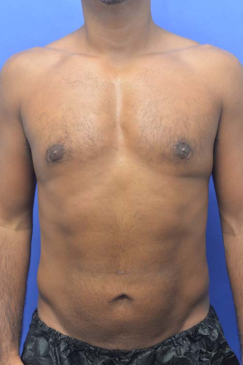 Liposuction Before and After | simply males