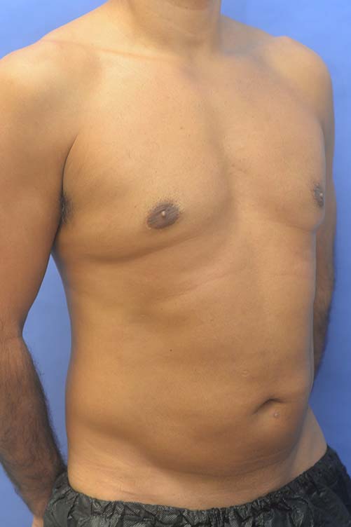 Liposuction Before and After | simply males